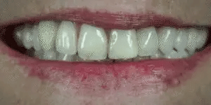 LumaGrin Quick Snap Veneers For Upper And Lower Teeth