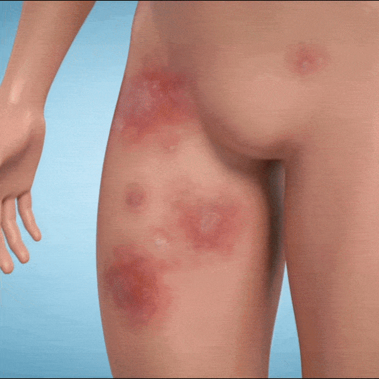 Mantar Cilt Bakımı için Antifungal Vücut Yıkama