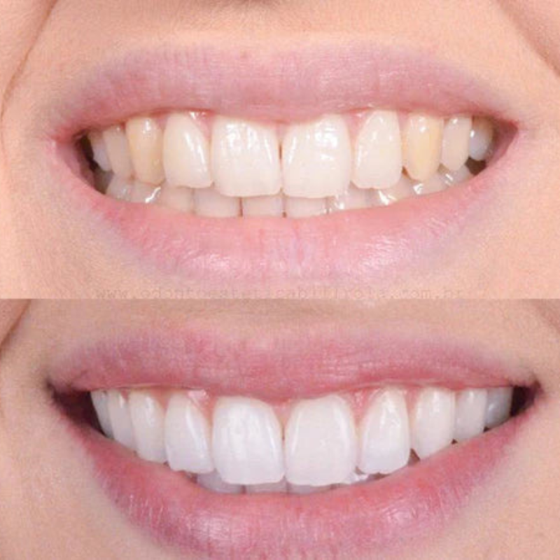 Swift Pro Edition illumina il tuo sorriso con uno sbiancamento dentale rapido