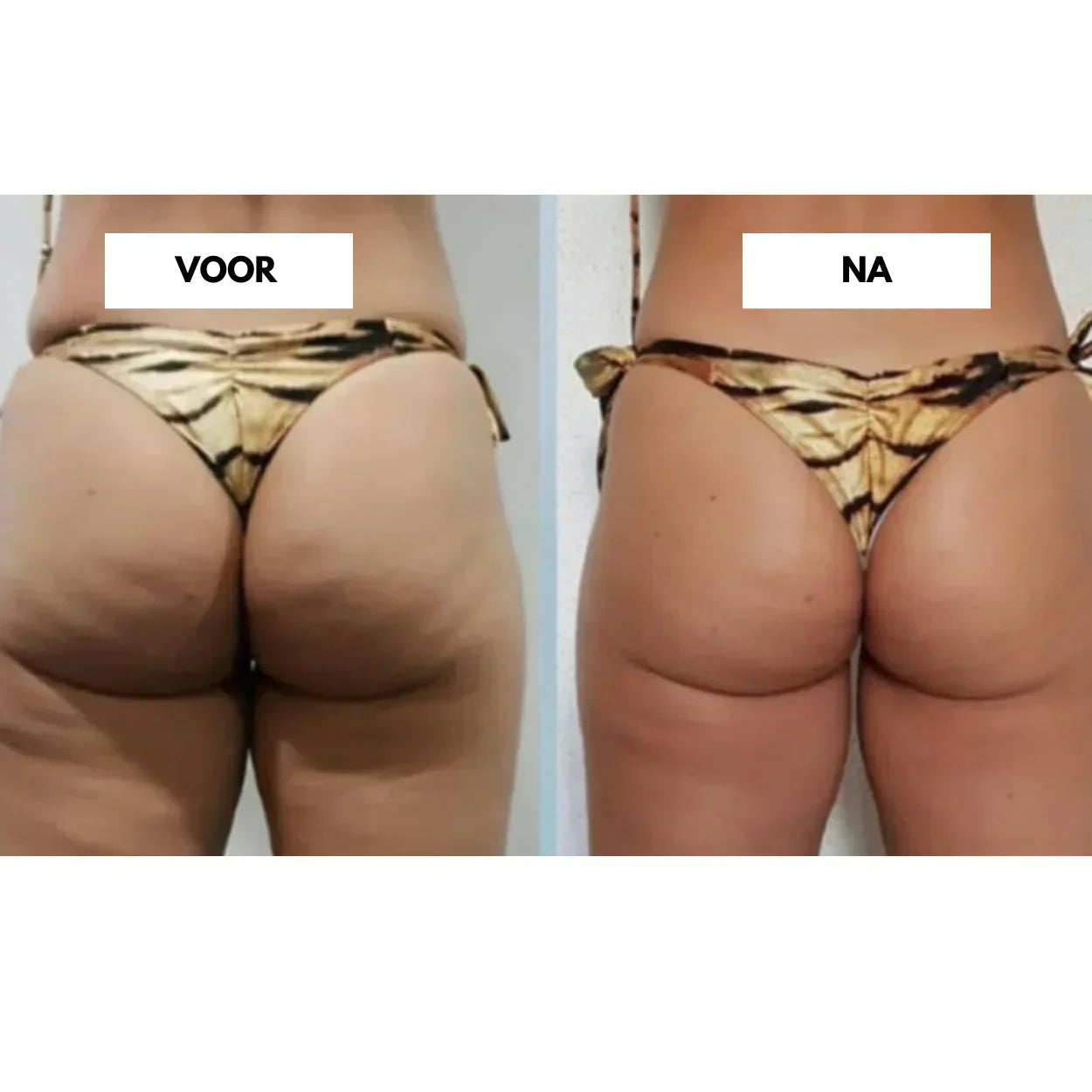 CelluLift dybvævsvakuummassage for fastere hud