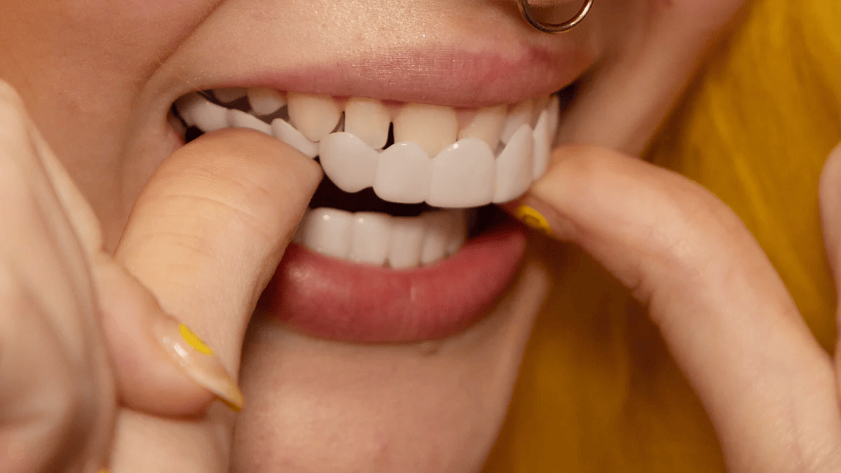 LumaGrin Quick Snap Veneers For Upper And Lower Teeth