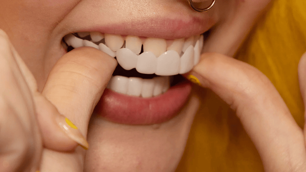 Nakładki Snap-On Veneers od NovaBright – szybki, naturalny uśmiech na górne i dolne zęby