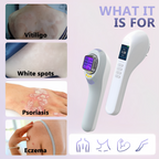 Lumière pour vitiligo et psoriasis à domicile avec lampe UVB 308 nm