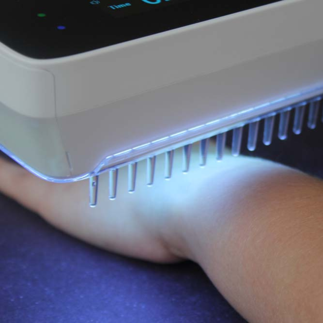 AureaBeam Handheld UVB Narrowband Phototherapy Lamp For Domestic Use