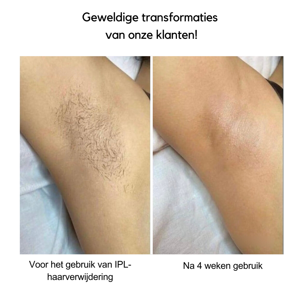 Safe At-Home Hair Removal With IPL For Long-Lasting Smooth Skin