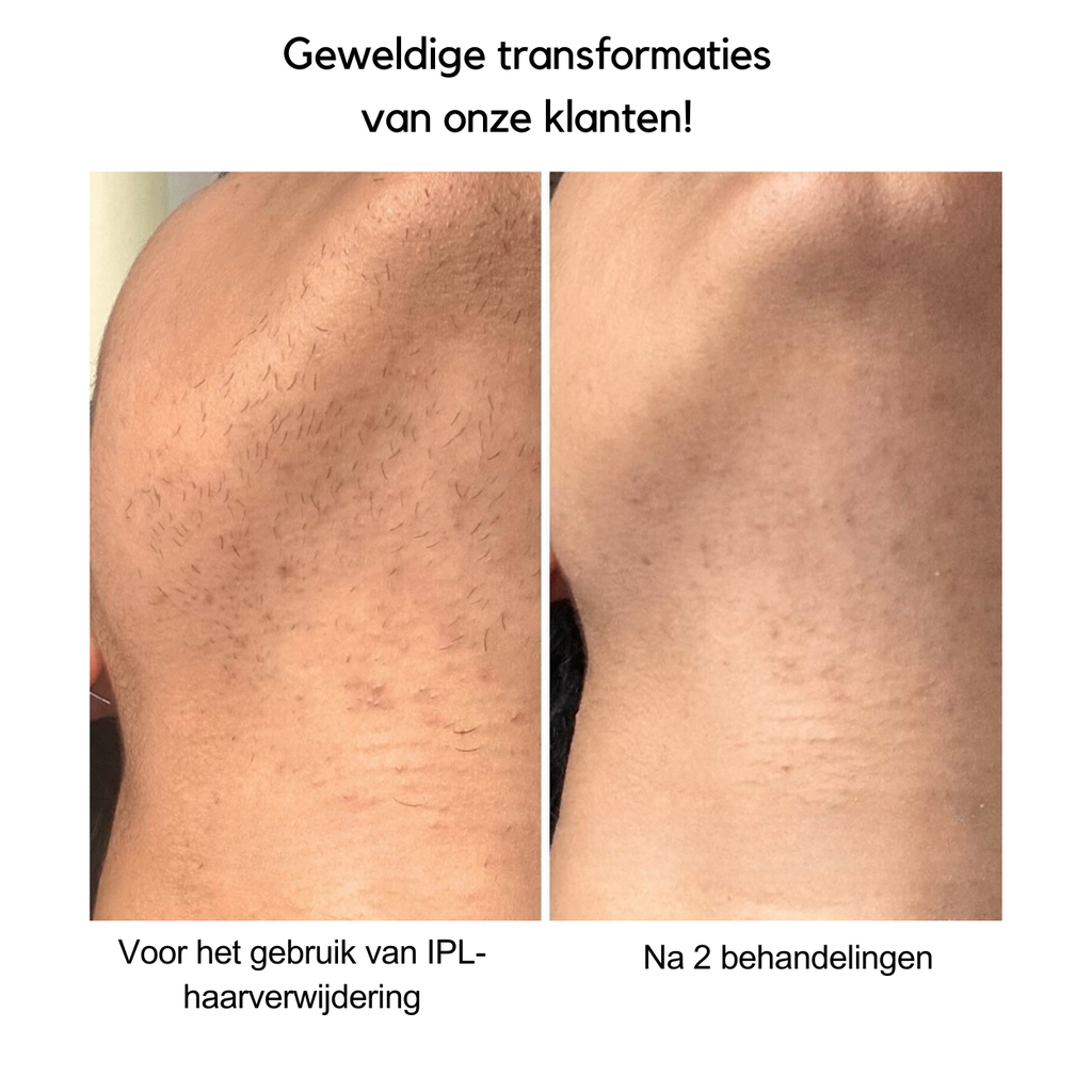 Safe At-Home Hair Removal With IPL For Long-Lasting Smooth Skin