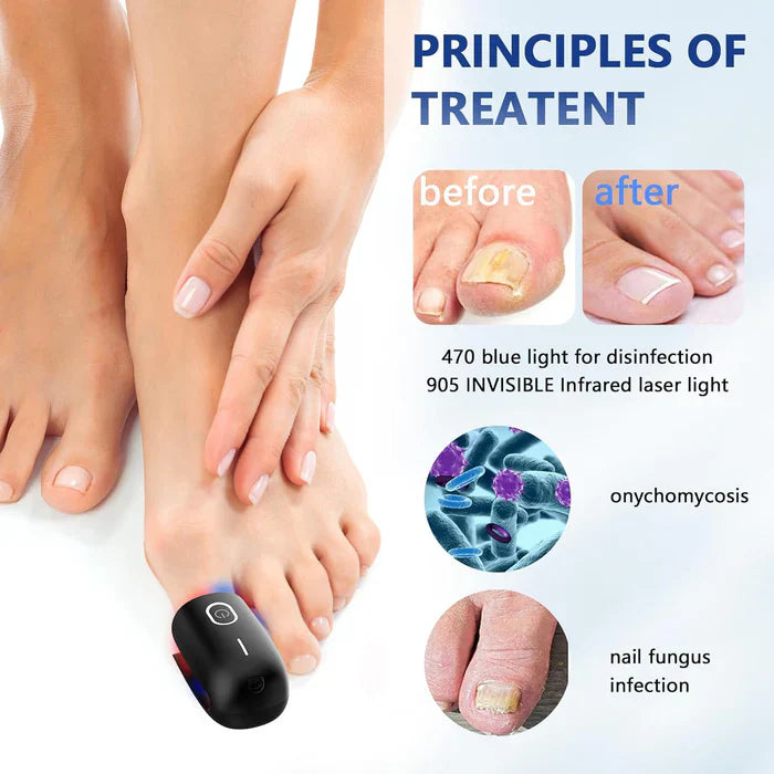 Dreiwellenlängen-Nagellaser für Fingernägel und Zehennägel System