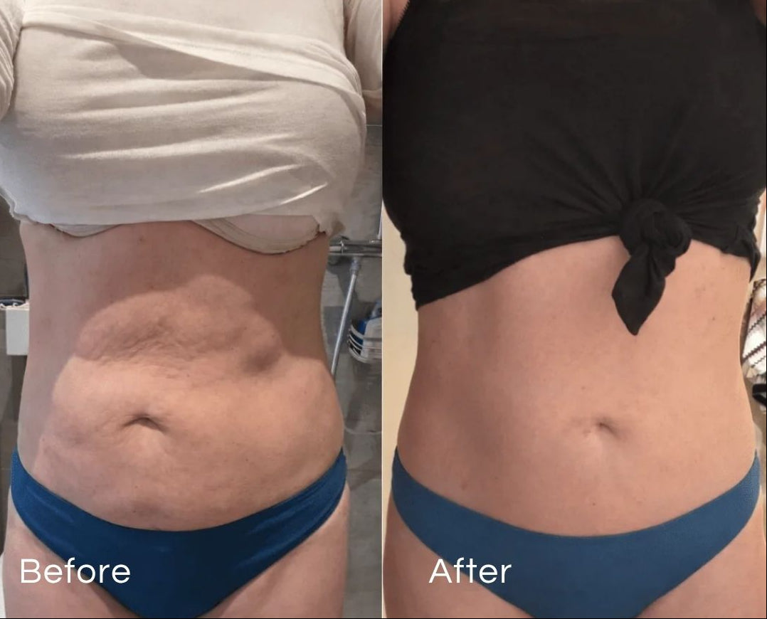Dispositivo 4-in-1 per il rimodellamento e la levigatura del corpo per uso domestico