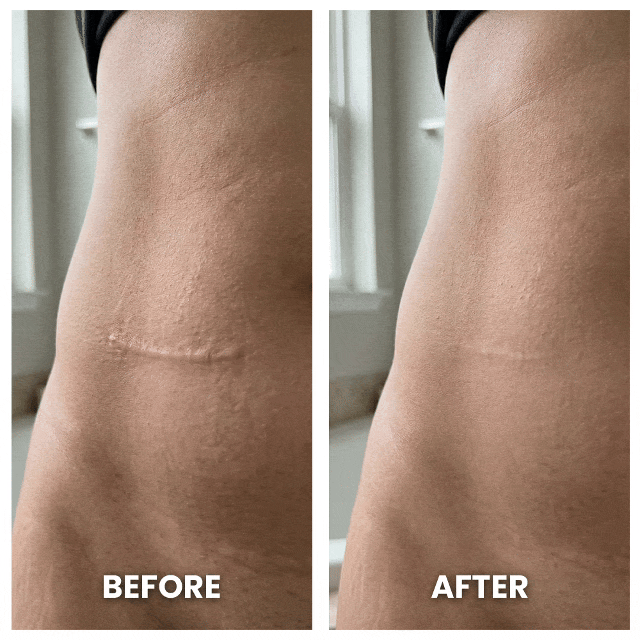 SilkScar Silicone Tape | Medical-Grade Scar Treatment for Flat, Soft Scars