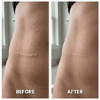 SilkScar Silicone Tape | Medical-Grade Scar Treatment for Flat, Soft Scars
