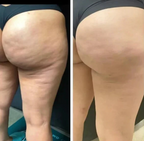 SilkSculpt intenzív cellulit elleni és bőrsimító testolaj
