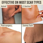 SilkScar Silicone Tape | Medical-Grade Scar Treatment for Flat, Soft Scars