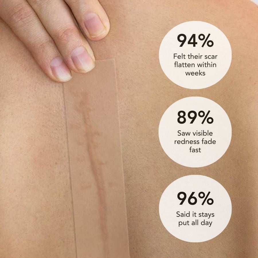 SilkScar Silicone Tape | Medical-Grade Scar Treatment for Flat, Soft Scars