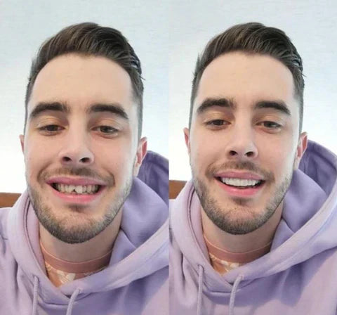 Snap-On Veneers By NovaBright Create Quick, Natural-Looking Smile For Upper And Lower Teeth