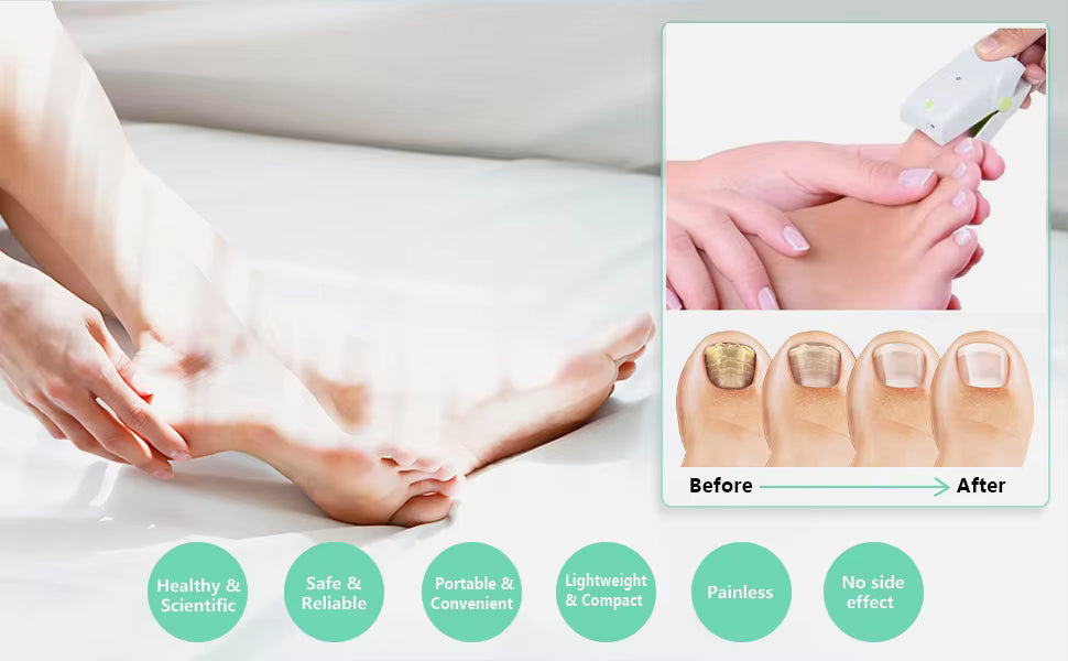 NovaNail Home Laser For Nail Fungus On Fingers And Toes