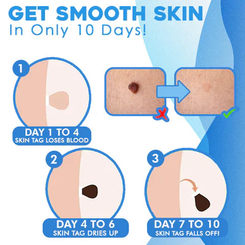 LumaDerm fjernelsessæt til hudmærker med målrettet applikator til hjemmebrug