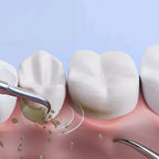OralPro Ultraschall-Zahnsteinentfernungsgerät für die Zahnsteinreinigung zu Hause