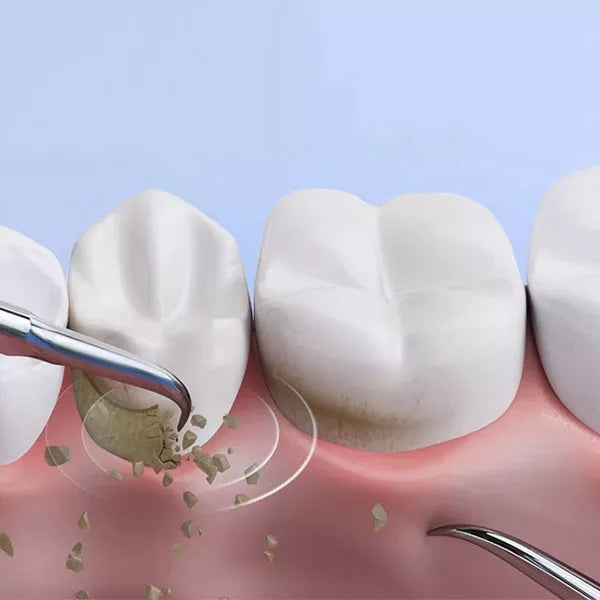 OralPro Ultraschall-Zahnsteinentfernungsgerät für die Zahnsteinreinigung zu Hause