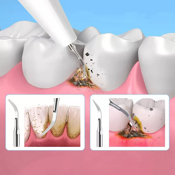 OralPro Ultraschall-Zahnsteinentfernungsgerät für die Zahnsteinreinigung zu Hause