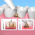OralPro Ultraschall-Zahnsteinentfernungsgerät für die Zahnsteinreinigung zu Hause