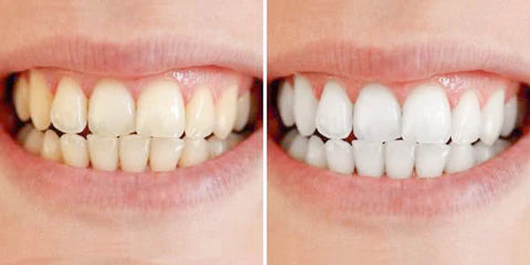 Swift Pro Edition illumina il tuo sorriso con uno sbiancamento dentale rapido