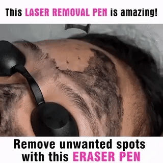 LumiDerm Home Laserstift zur Tattooentfernung, Muttermalen und Sommersprossen
