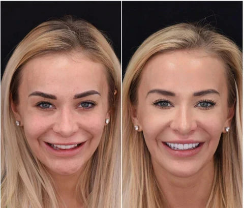 Snap-On Veneers By NovaBright Create Quick, Natural-Looking Smile For Upper And Lower Teeth