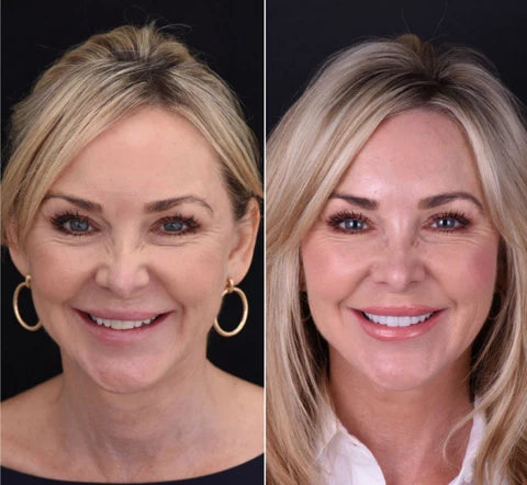 LumaGrin Quick Snap Veneers For Upper And Lower Teeth