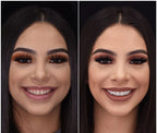 LumaGrin Quick Snap Veneers For Upper And Lower Teeth