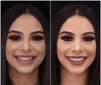 Nakładki Snap-On Veneers od NovaBright – szybki, naturalny uśmiech na górne i dolne zęby
