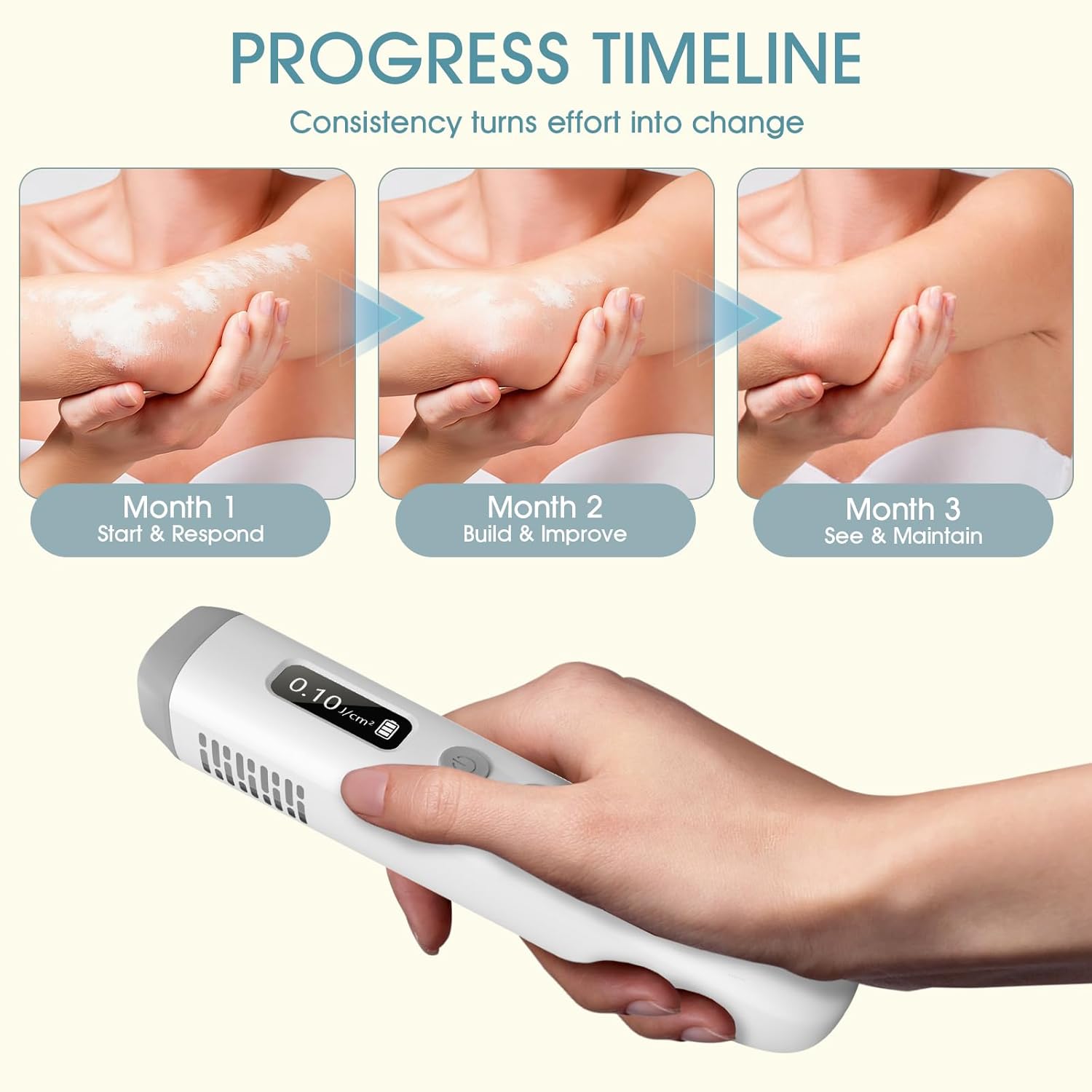 Dispositivo de Fototerapia UVB Portátil 308nm 2026 – Tratamiento en Casa para Psoriasis, Eccema, Vitiligo y Más