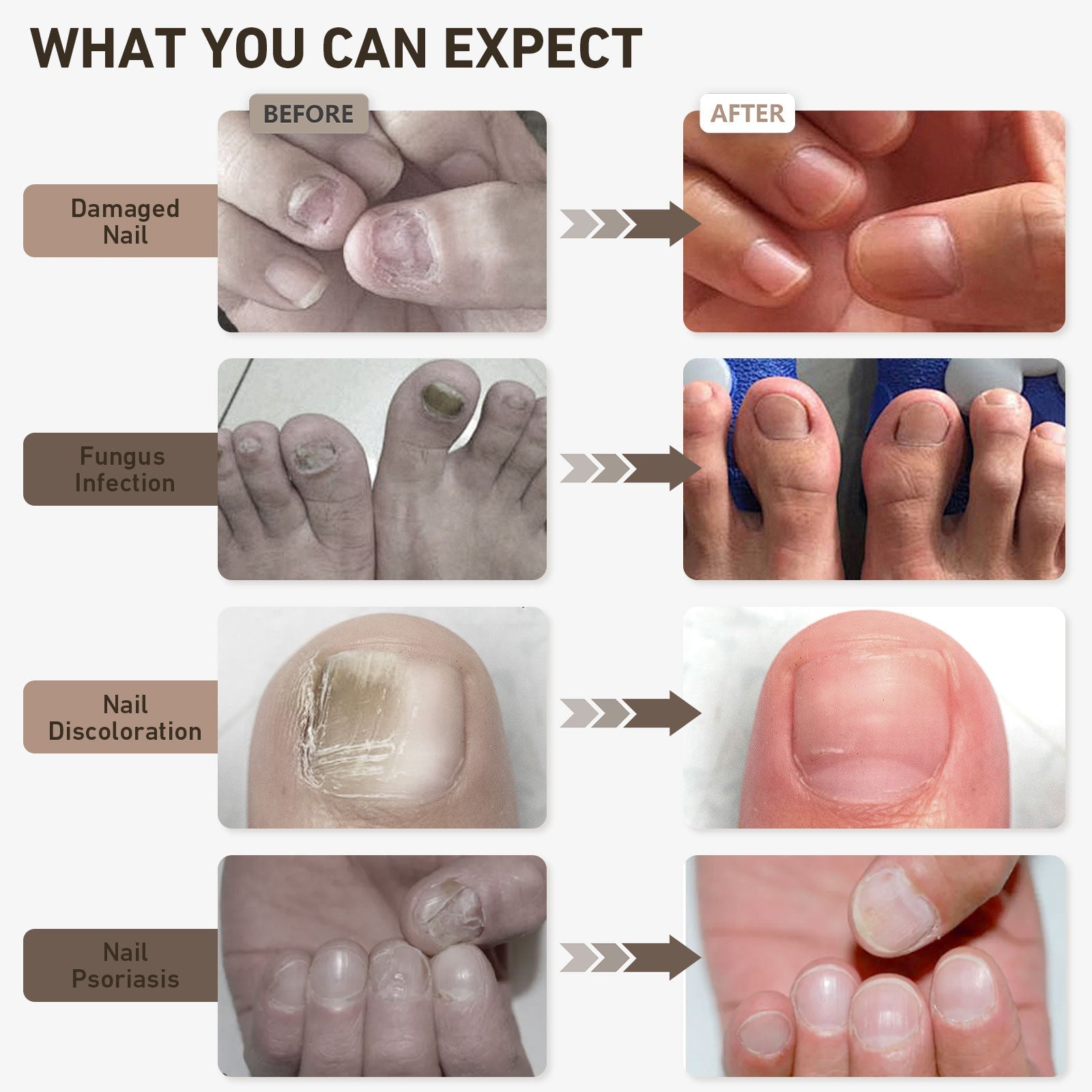 Nagelvernieuwingslichtapparaat – Blauw- en roodlichttherapie voor gezondere, helderder uitziende nagels