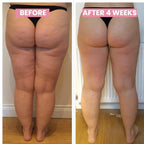 CelluLift Skin Tightening Vacuum Massage For Women With Cellulite